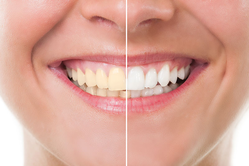 Teeth Whitening in Pea Ridge